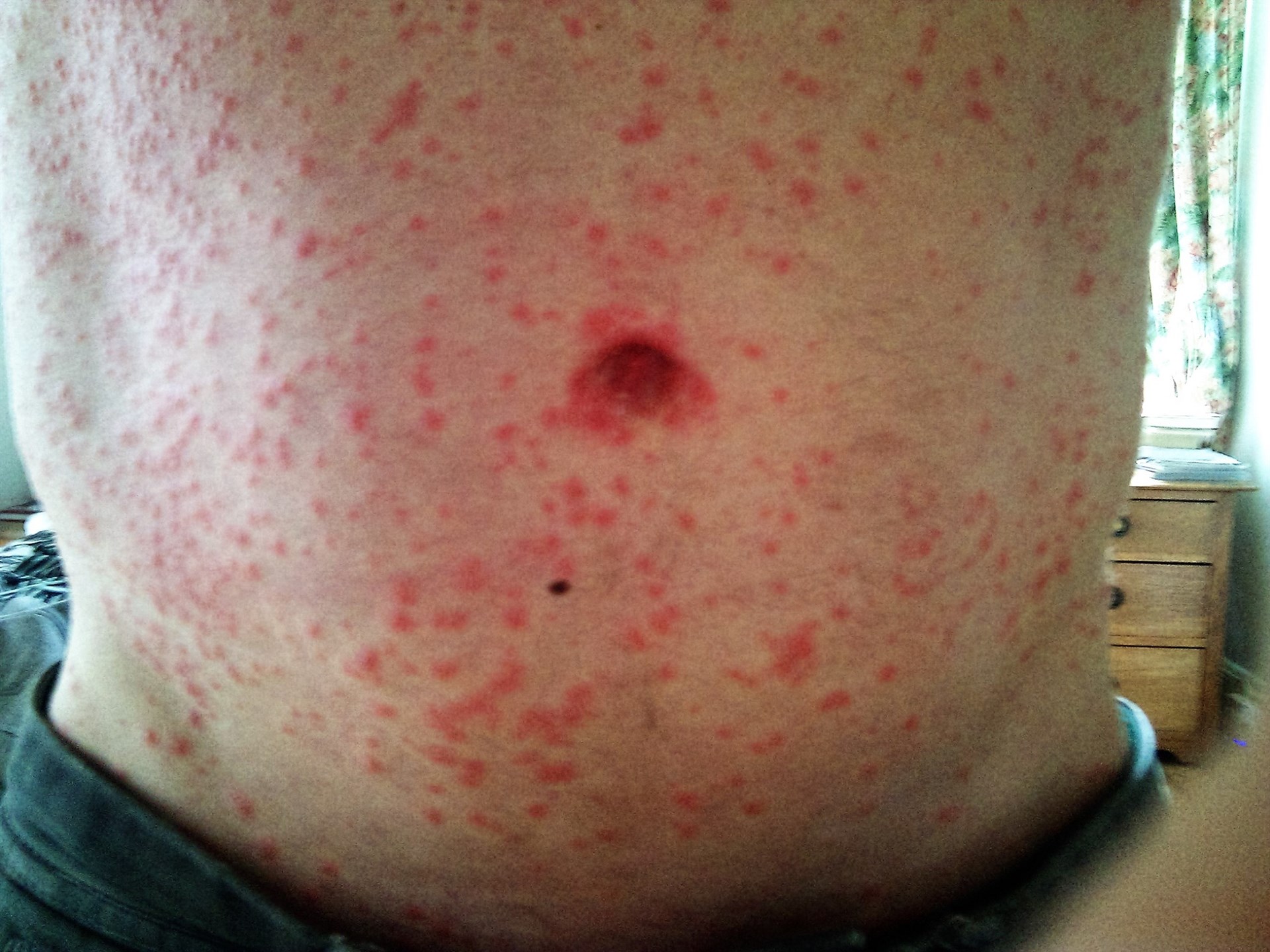 En alerta Sinaloa por la fiebre Mayaro