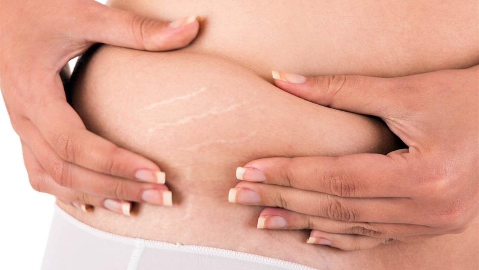 Obesidad puede provocar múltiples daños en la piel