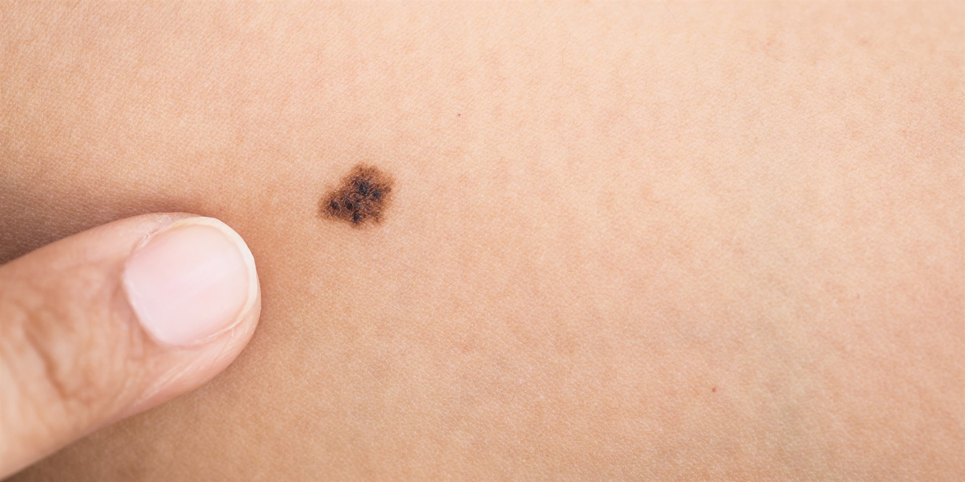 Personas de piel blanca son más propensas a desarrollar cáncer