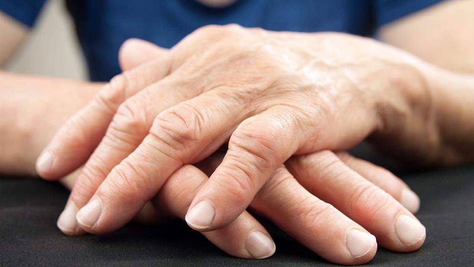 Artritis reumatoide, mal que genera deformidad en manos y pies
