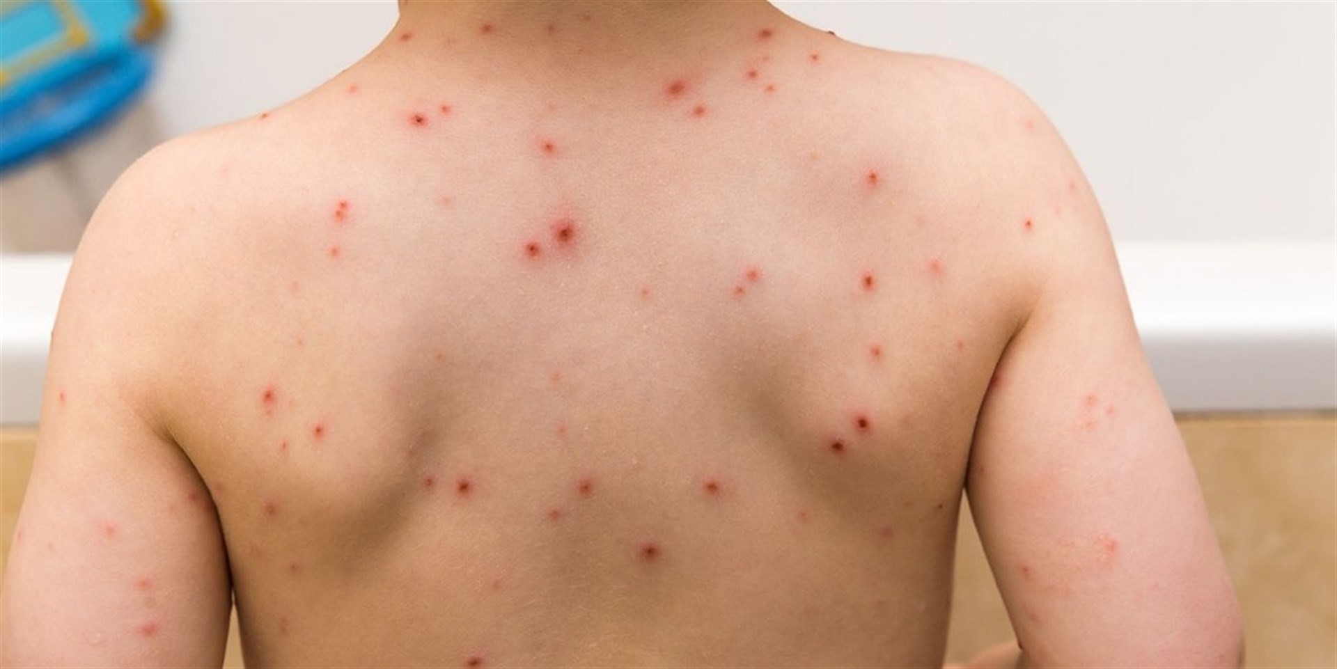 Alertan de los primeros casos de varicela en la región