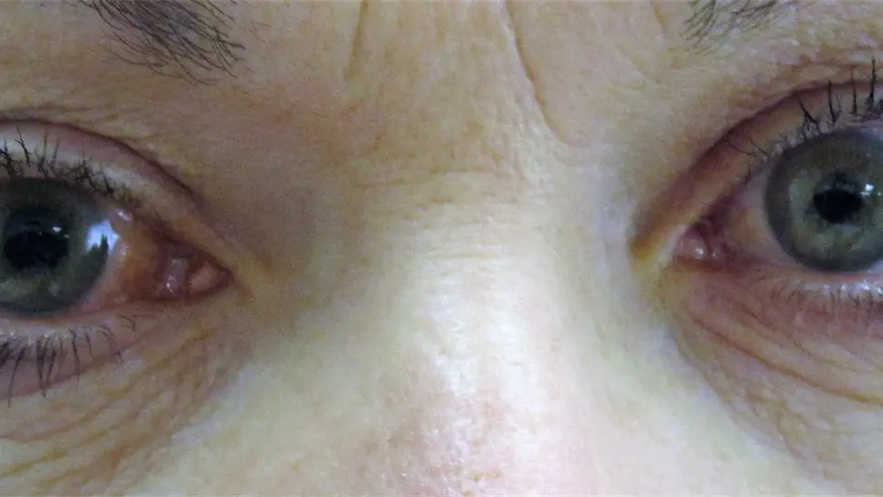 Glaucoma, enfermedad que produce pérdida gradual de la visión