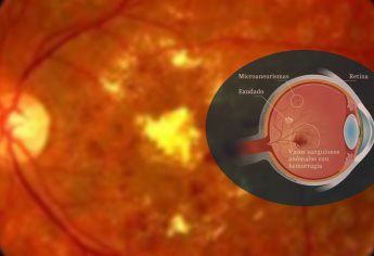 Retinopatía diabética, de las principales causas de ceguera en México