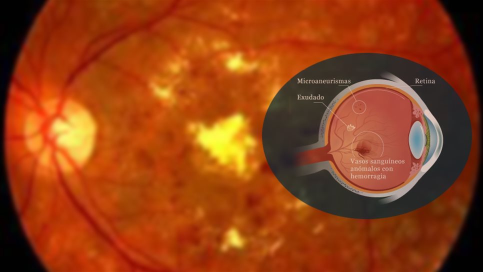 Retinopatía diabética, de las principales causas de ceguera en México