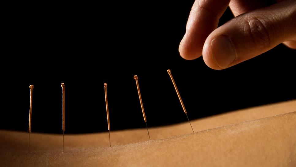 Acupuntura China puede tratar más de 300 enfermedades Acupuntura China puede tratar más de 300 enfermedades