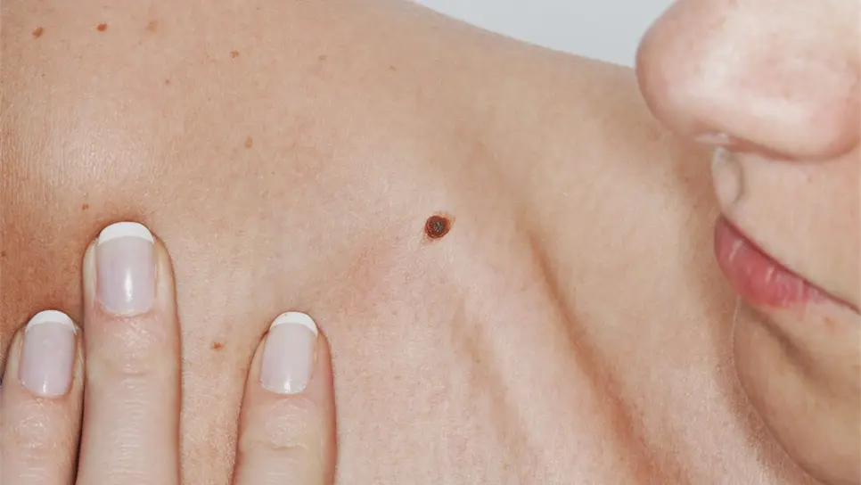 Piden detectar síntomas iniciales de cáncer de piel