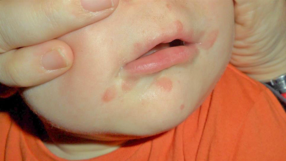 Virus de Coxsackie, afecta a menores de 5 años en guarderías