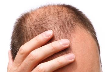 La mitad de hombres jóvenes pierden cabello por estrés y hormonas
