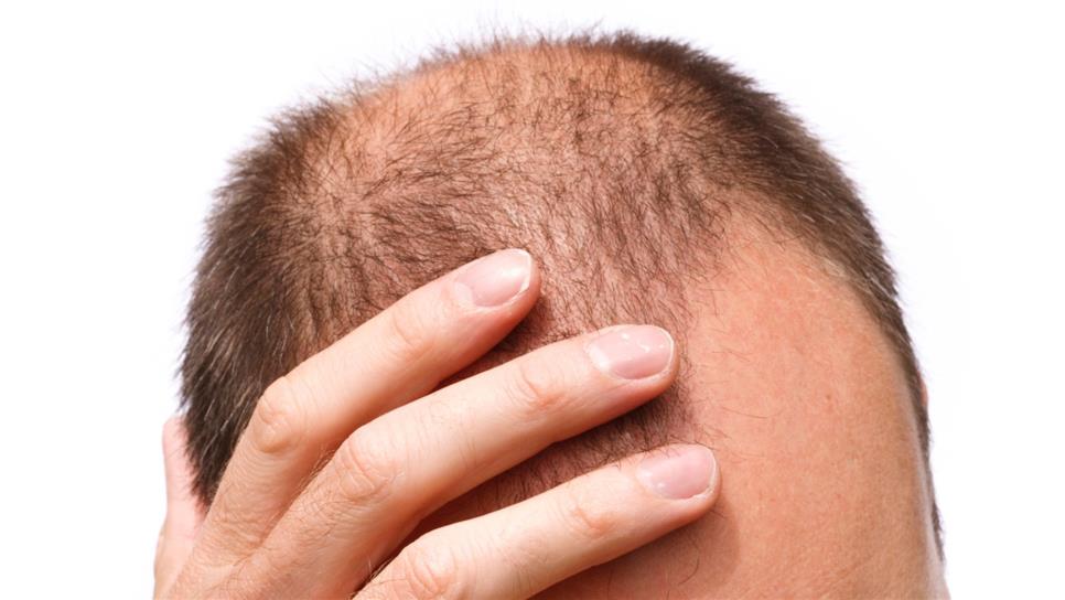 La mitad de hombres jóvenes pierden cabello por estrés y hormonas