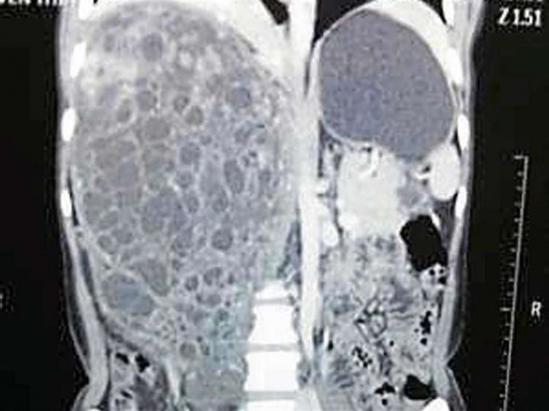 Extirpan tumor 36 veces más grande que un riñón