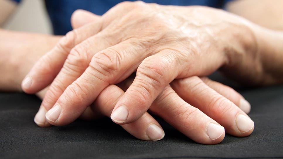 Artritis reumatoide pueda restar hasta 10 años de vida a pacientes