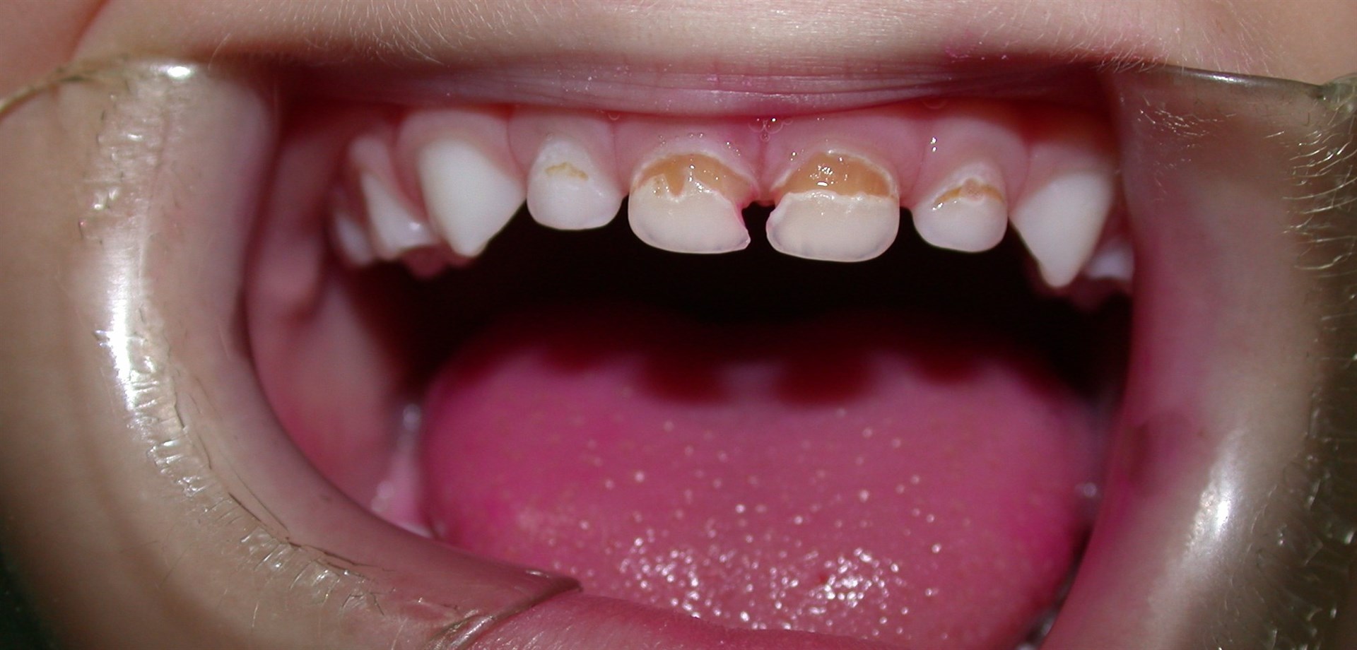 Aumentan casos de cáncer bucal y pérdida de dientes en niños