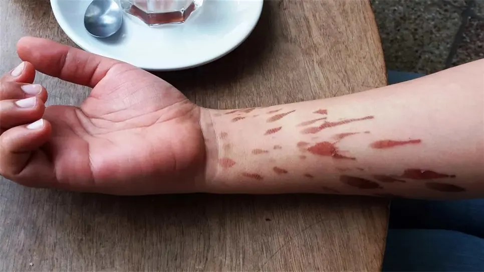 Remedios caseros en quemaduras pueden aumentar el daño