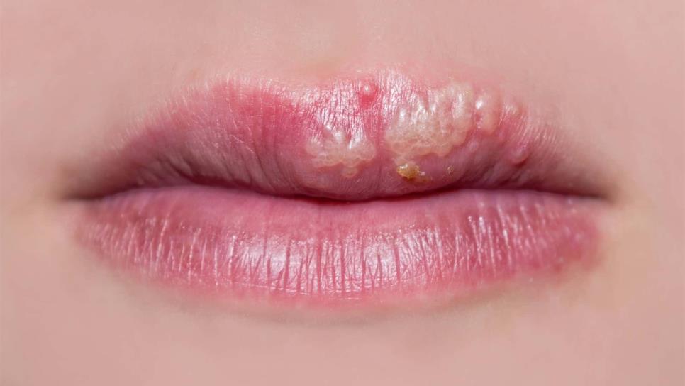 Advierten que herpes labial puede contagiarse a genitales