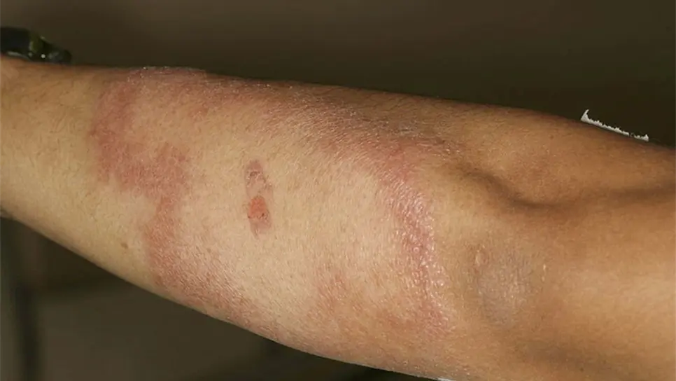 Sinaloa el estado con más lepra: SSA