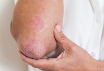 Advierten que 2.5 millones de mexicanos padecen psoriasis