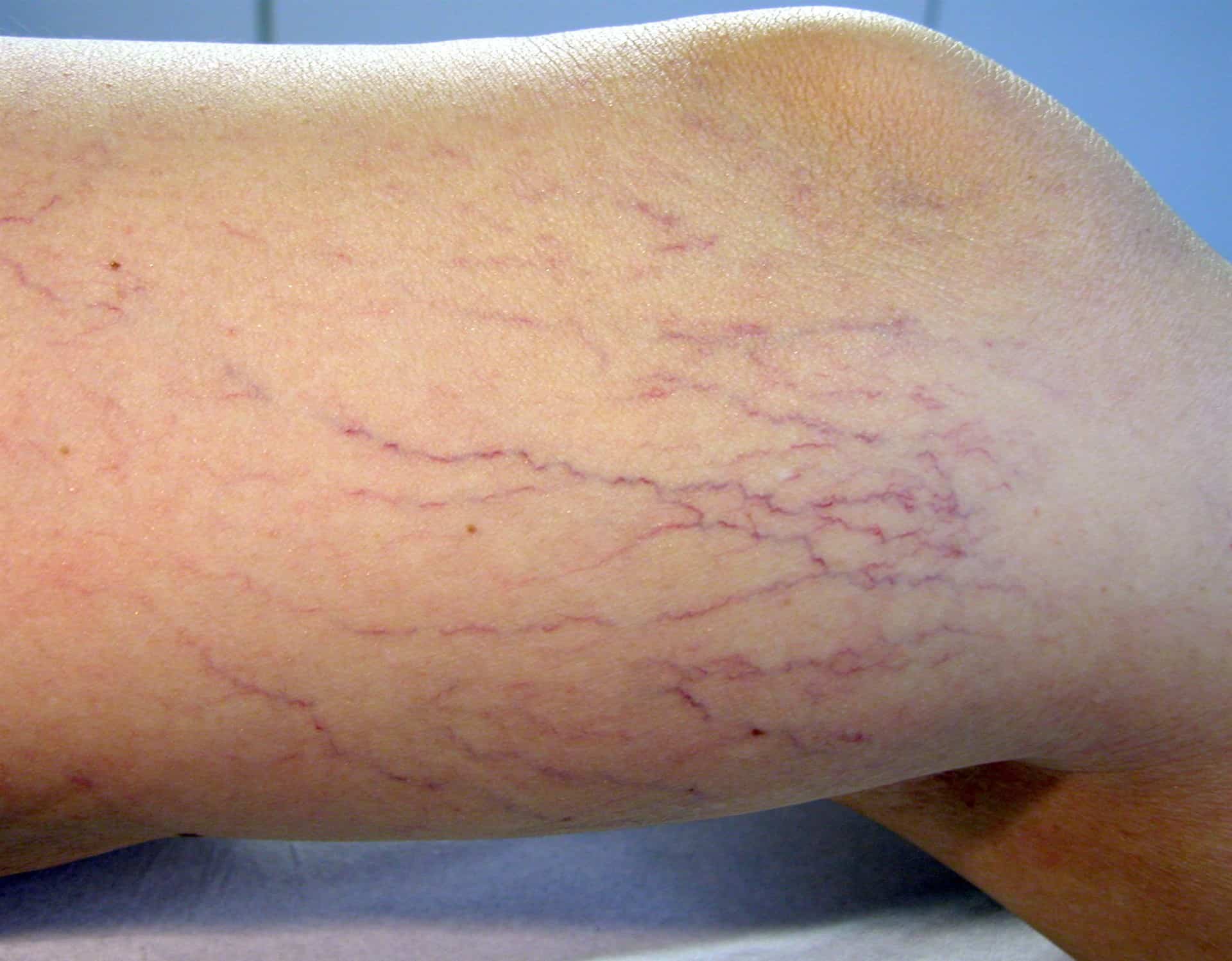 Recomiendan caminar diario para evitar várices