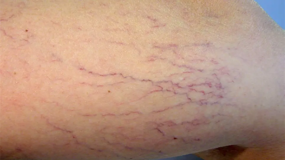 Atiende IMSS anualmente más de 37 mil casos de várices