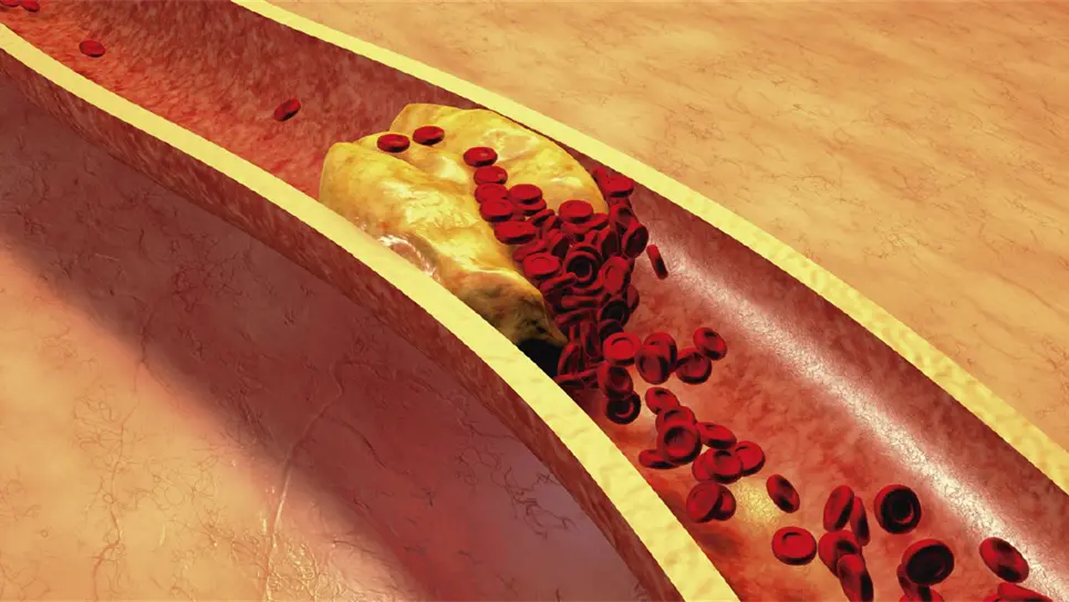 Nueva molécula ayuda a reducir niveles de colesterol “malo”