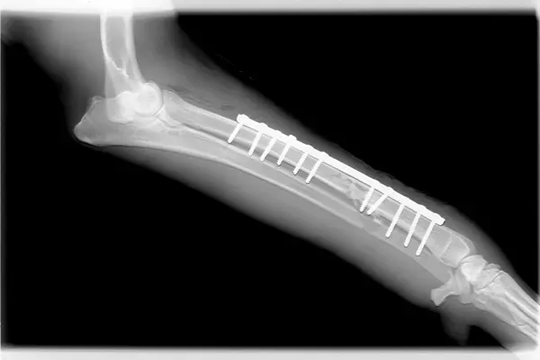 Advierten que hongos y bacterias crecen en implantes corporales Advierten que hongos y bacterias crecen en implantes corporales