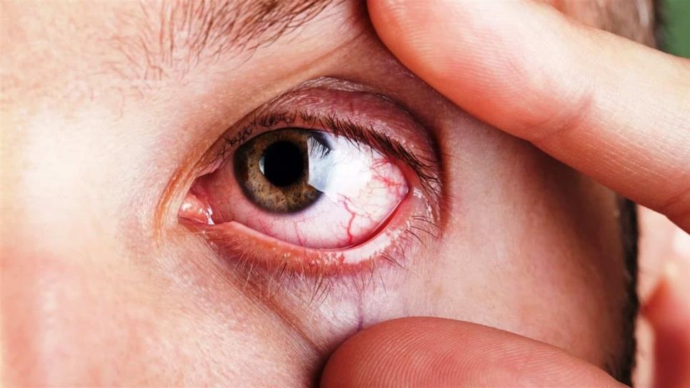 Síndrome de ojo seco afecta a 20 por ciento de la población