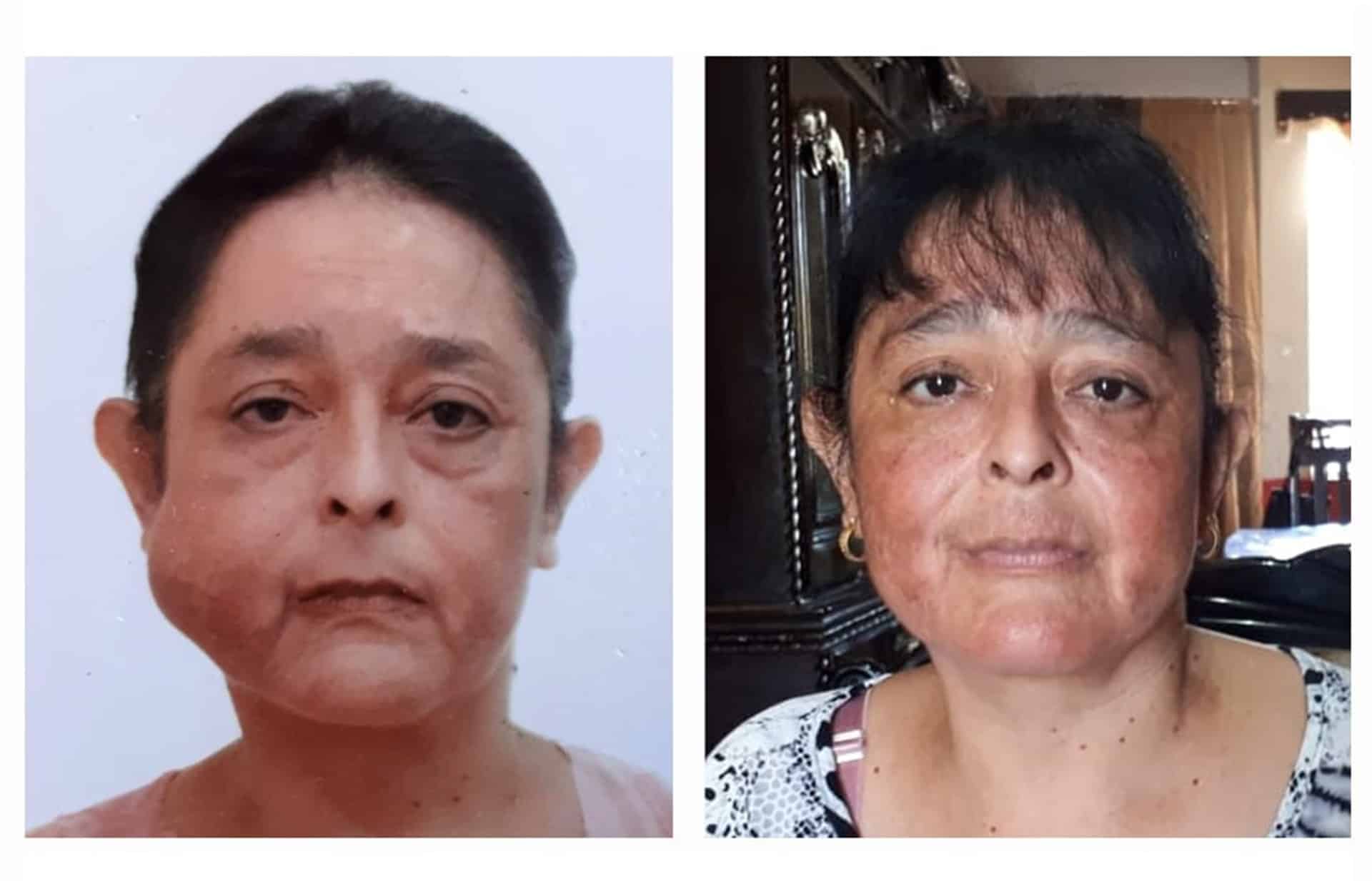 Vuelve a sonreir tras extirparle tumor en la cara