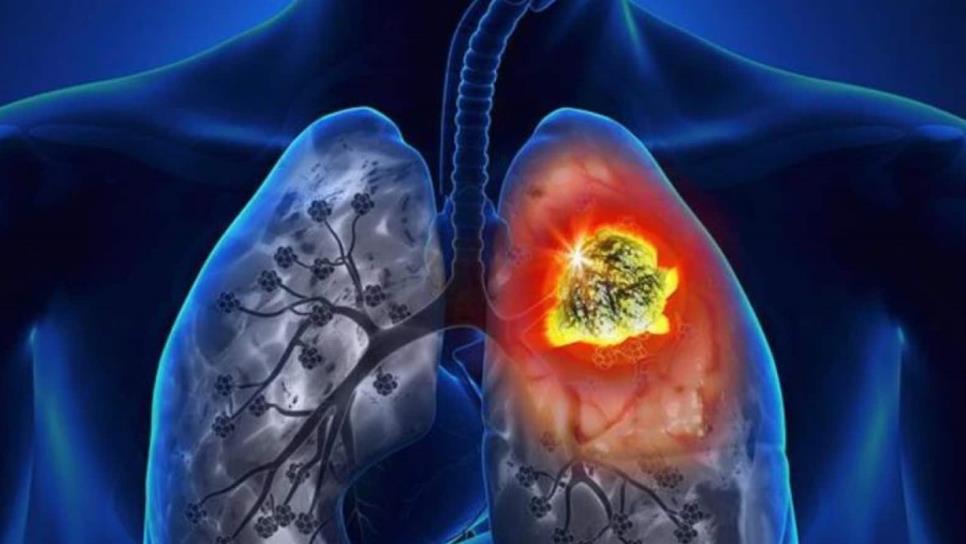 Esperan inmunoterapia contra cáncer de pulmón para 2020