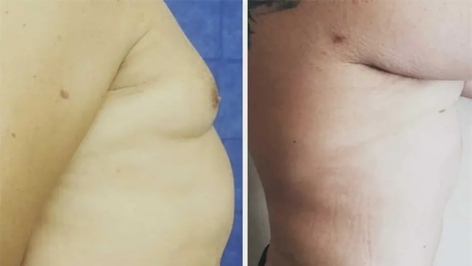 Perfil griego y senos grandes, las cirugías más solicitadas en México