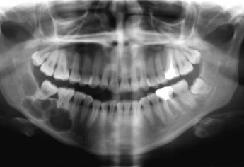 Dientes dañados podrían ser factor de riesgo para cáncer de boca