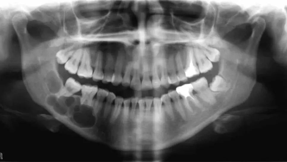 Dientes dañados podrían ser factor de riesgo para cáncer de boca