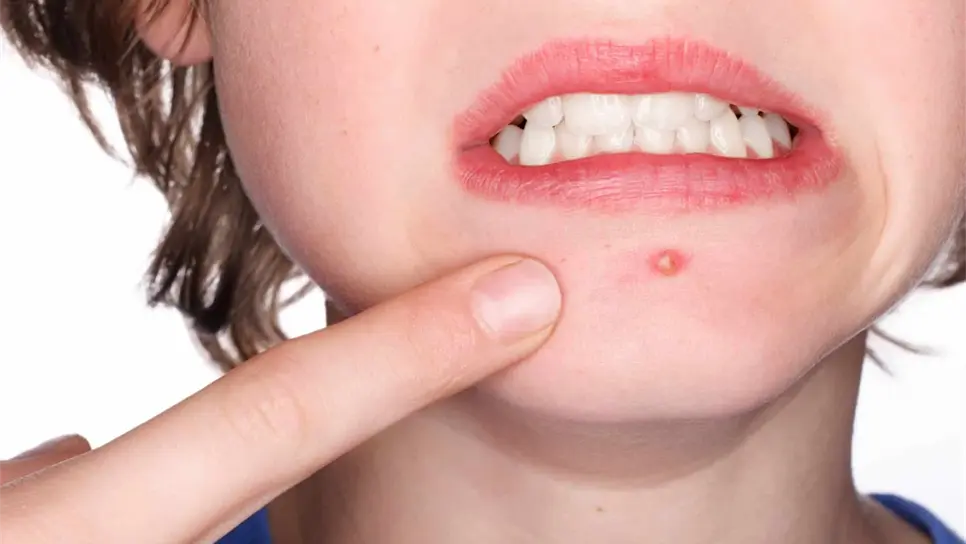 Acné en adultos afecta más a mujeres por factores hormonales