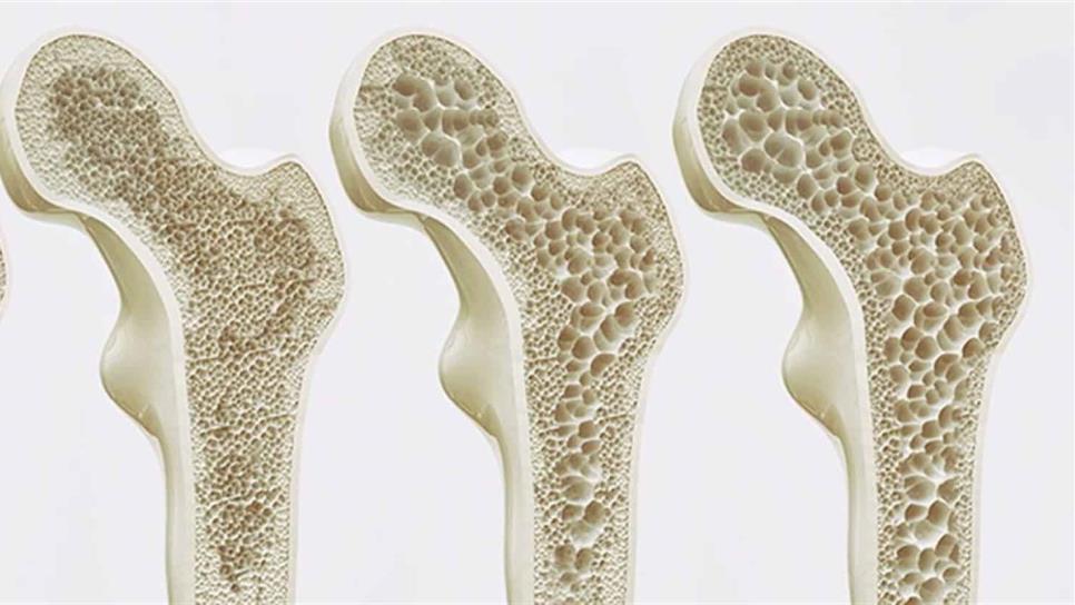 Fractura por osteoporosis, aumenta mortalidad en México