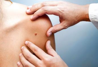 Cáncer de células de Merkel, raro pero agresivo tumor en la piel