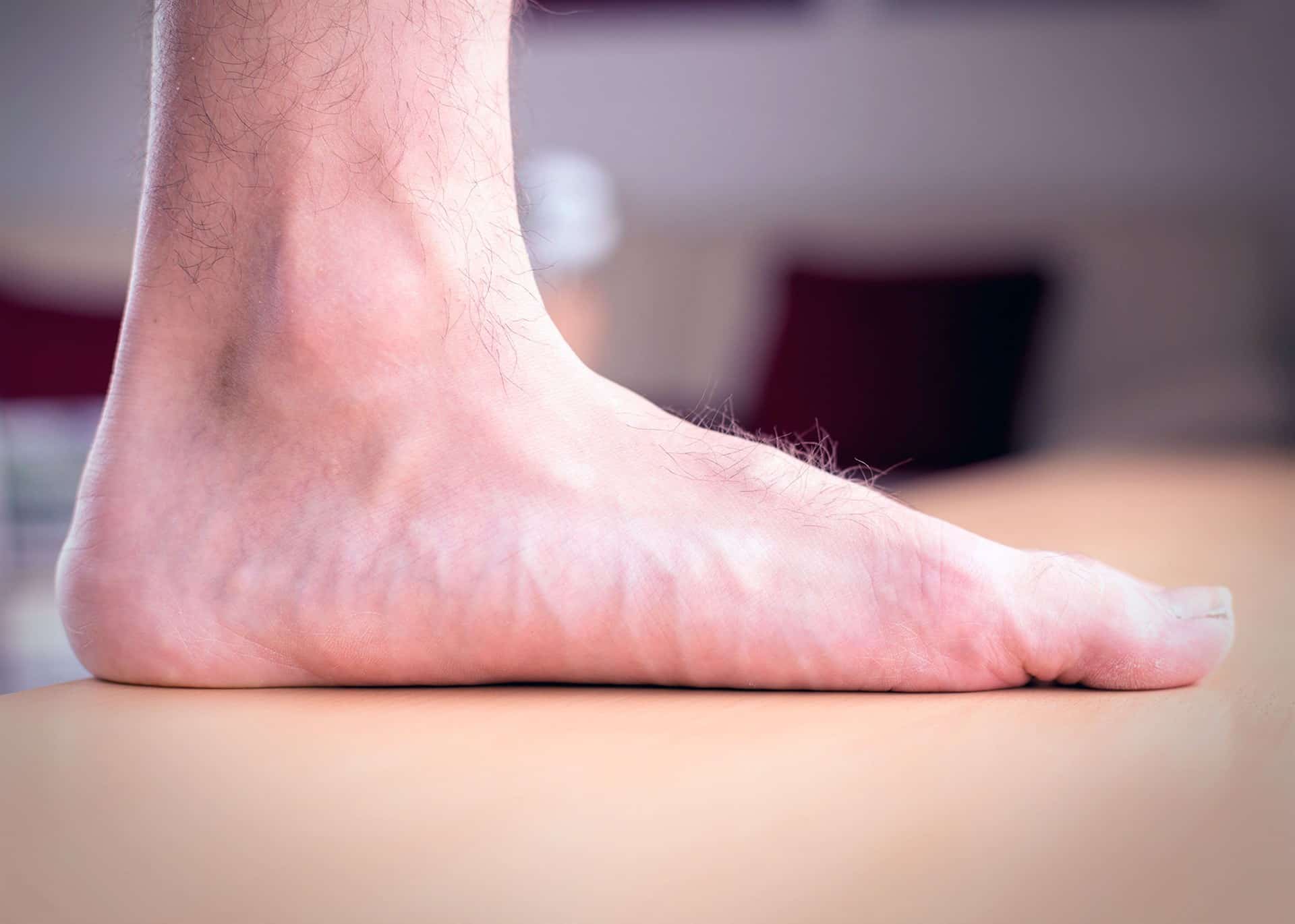 Recomiendan atender problemas ocasionados por el pie plano