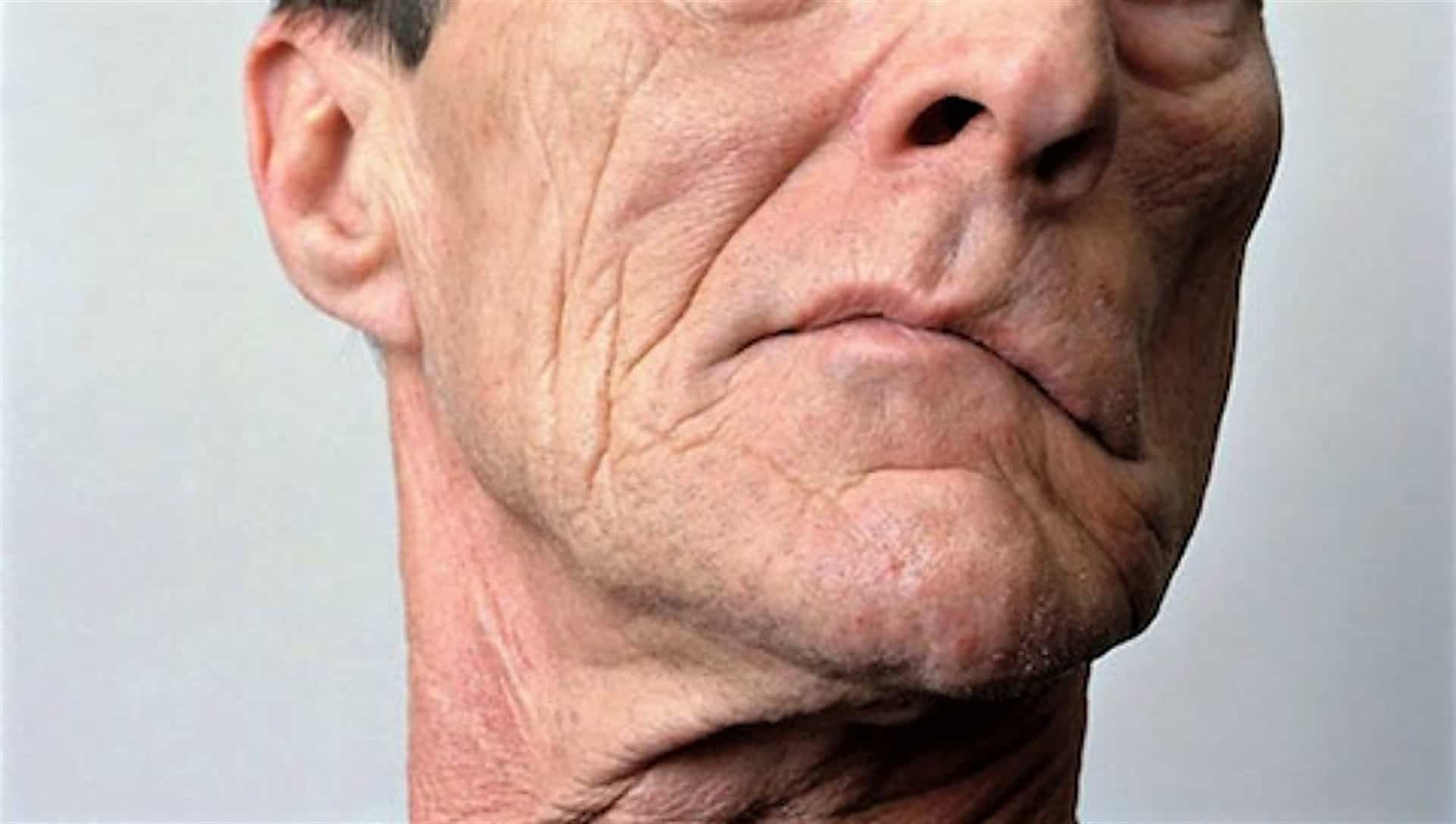 Parálisis facial aumenta en temporada invernal, dice especialista