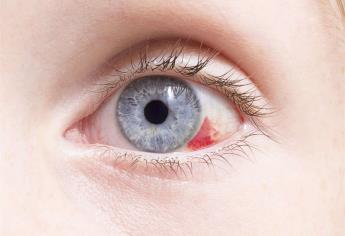 Descartan que derrame ocular cause problemas de visión