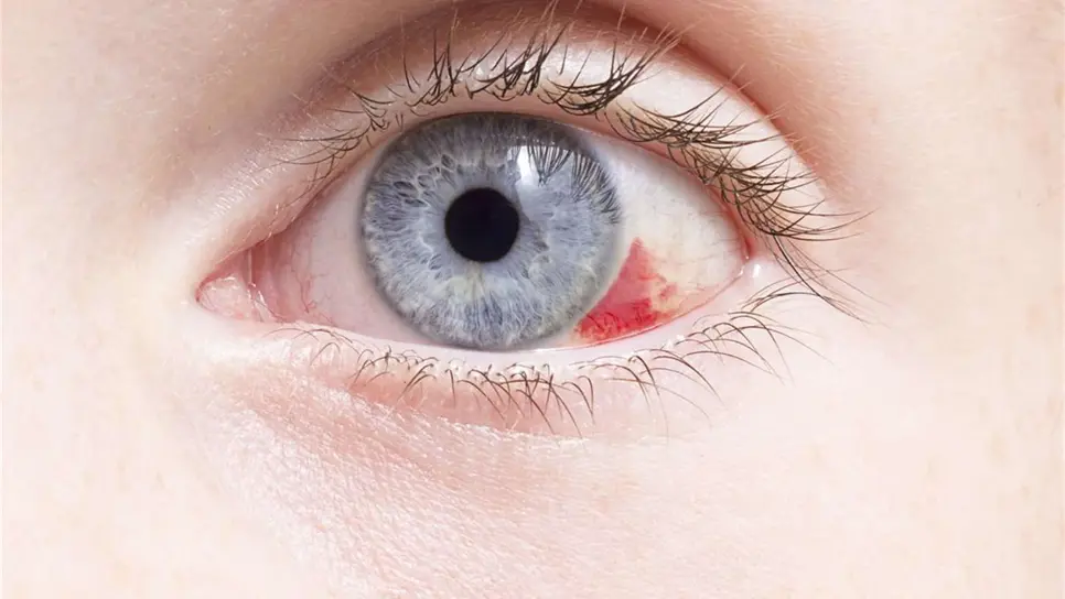 Descartan que derrame ocular cause problemas de visión