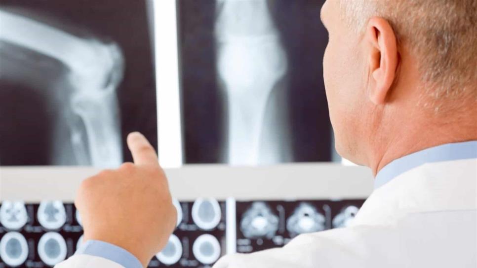 Uno de cada cinco hombres mayores de 50 años padece osteoporosis