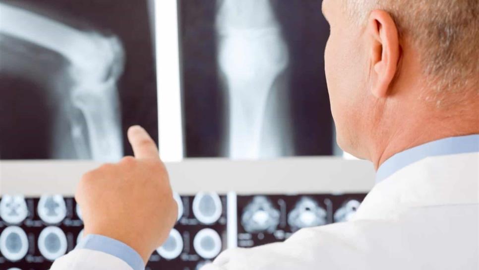 Osteoporosis cuesta a México más de 400 millones de dólares anuales