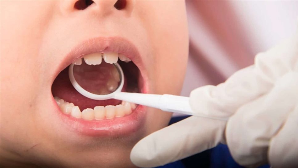 El 95% de los niños en edad escolar sufren de caries en Sinaloa El 95% de los niños en edad escolar sufren de caries en Sinaloa
