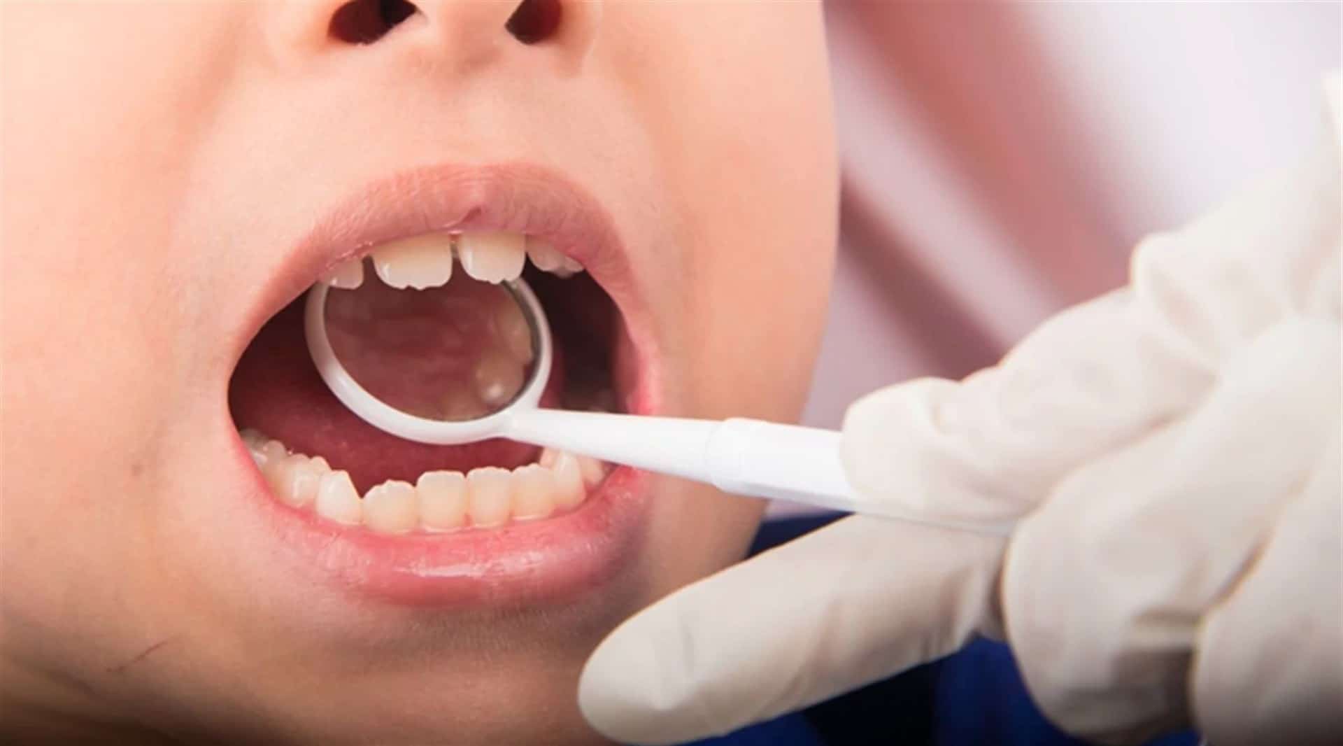 El 95% de los niños en edad escolar sufren de caries en Sinaloa