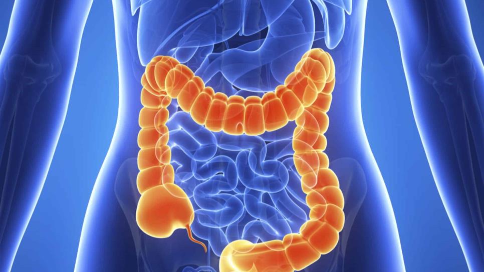 Cáncer de colon, segunda neoplasia más frecuente en mujeres y hombres