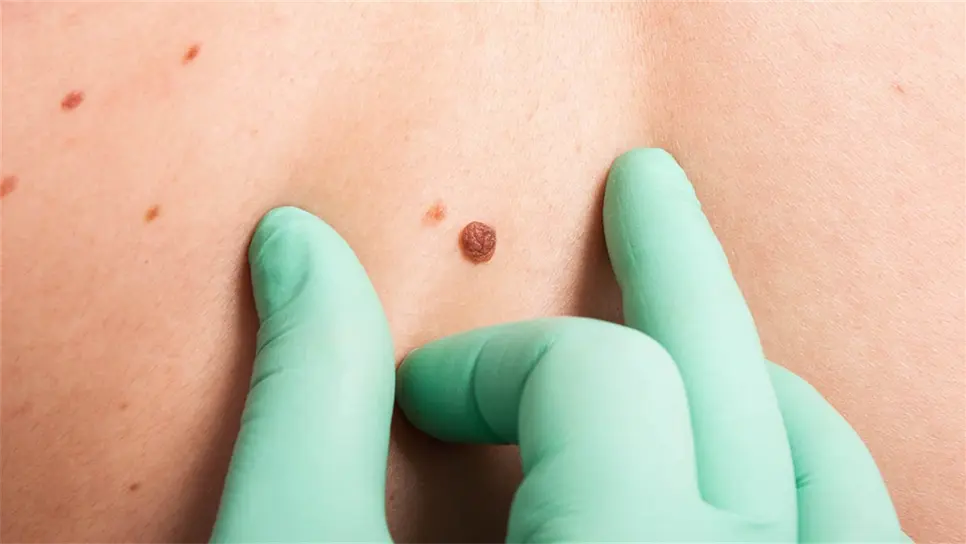 Llaman a prevenir cáncer de piel con uso de bloqueador solar FPS