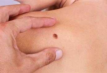 Melanoma afecta más a mujeres