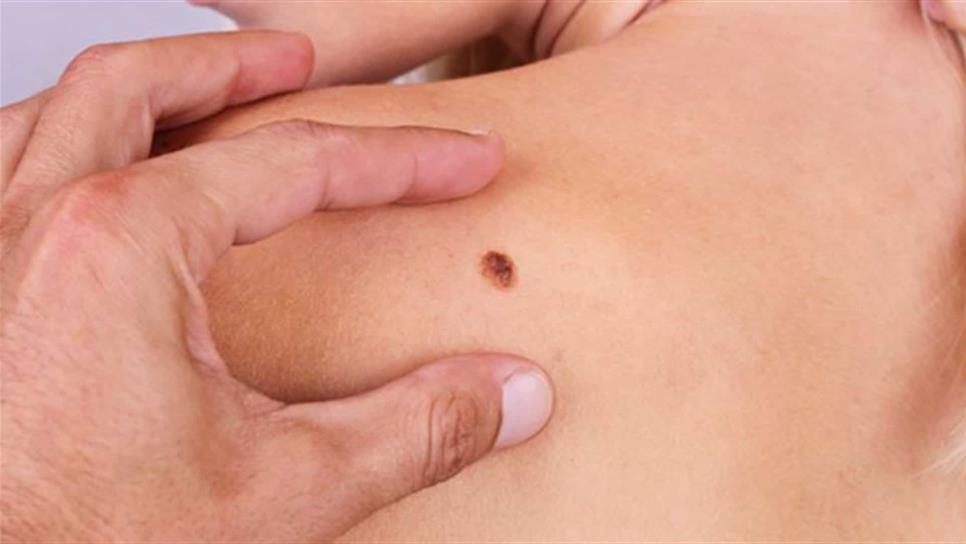 Melanoma afecta más a mujeres