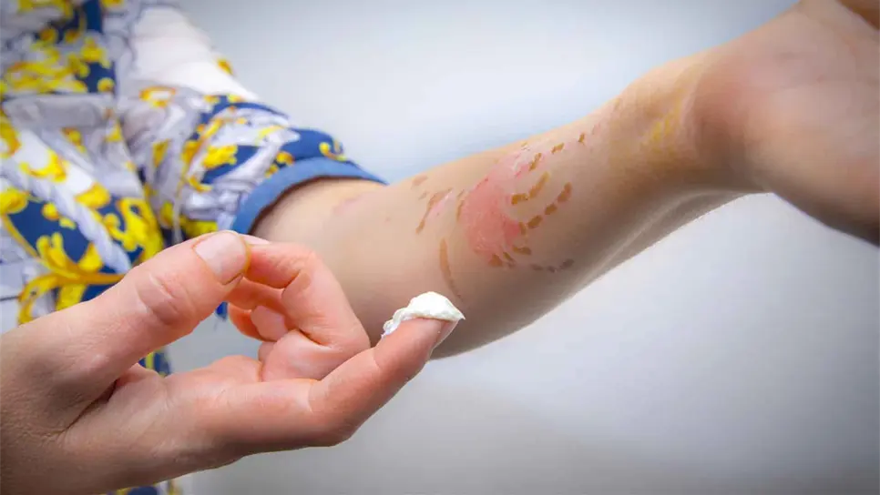 Ungüentos caseros para tratar úlceras y heridas, un riesgo para la salud