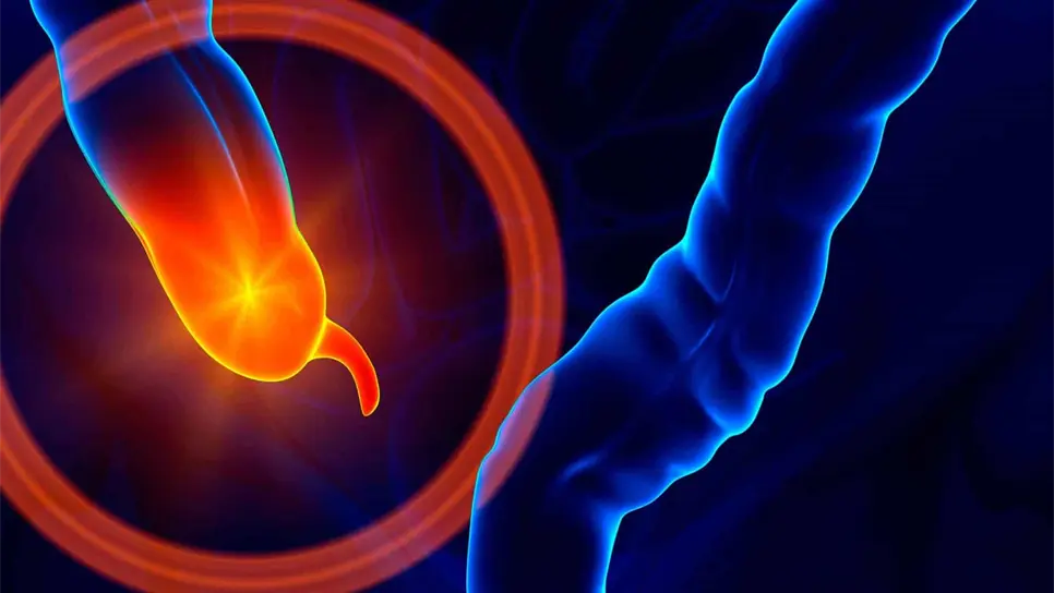 Extirpación de la apéndice podría proteger contra el Parkinson