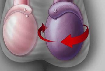 Torsión testicular, más frecuente entre los 12 y 18 años