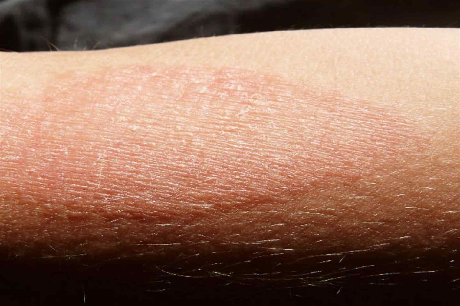 El 50% de las personas con enfermedades en la piel sufre depresión