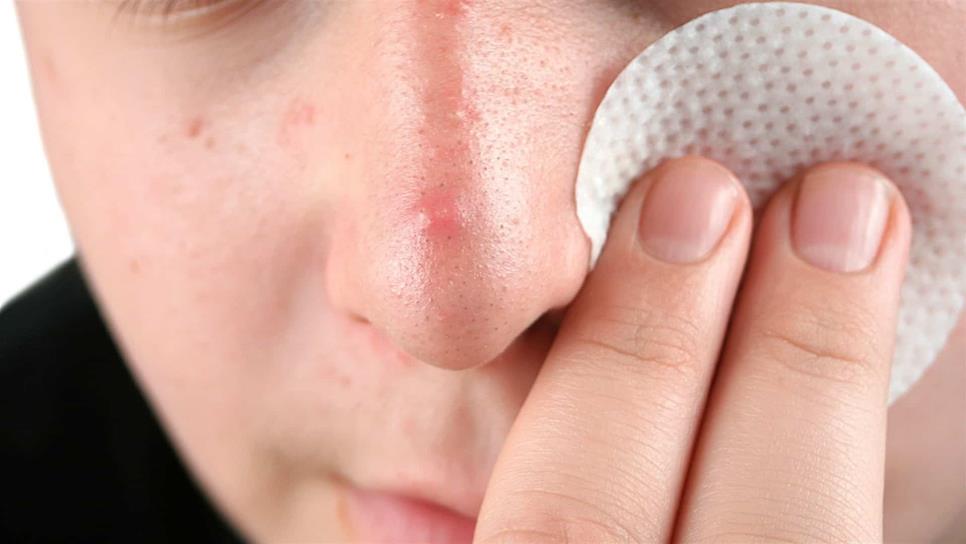Remedios caseros agravan cuadro clínico de acné: especialista